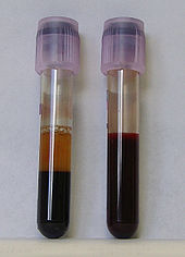 Two tubes of EDTA-anticoagulated blood. Left tube: after standing, the RBCs have settled at the bottom of the tube.