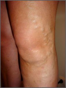 Image of varicose veins