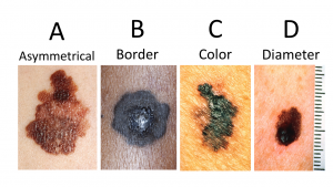 4 moles. Asymmetrical mole, mole with undefined borders, mole with irregular colors, mole with large/growing diameter.