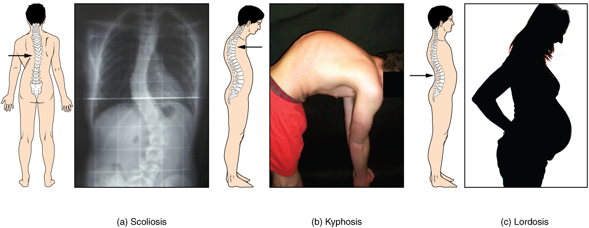 This image shows the changes to the abnormal curves of the vertebral columns in different diseases. The left panel shows the change in the curve of the vertebral column in scoliosis, the middle panel shows the change in the curve of the vertebral column in kyphosis, and the right panel shows the change in the curve of the vertebral column in lordosis