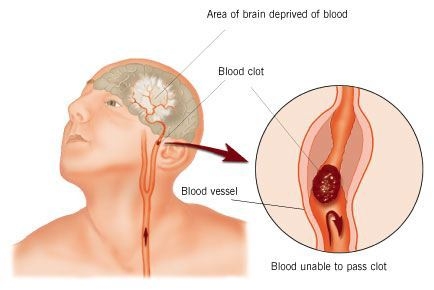 Illustration showing a stroke occurring within a person's head, with textual labels