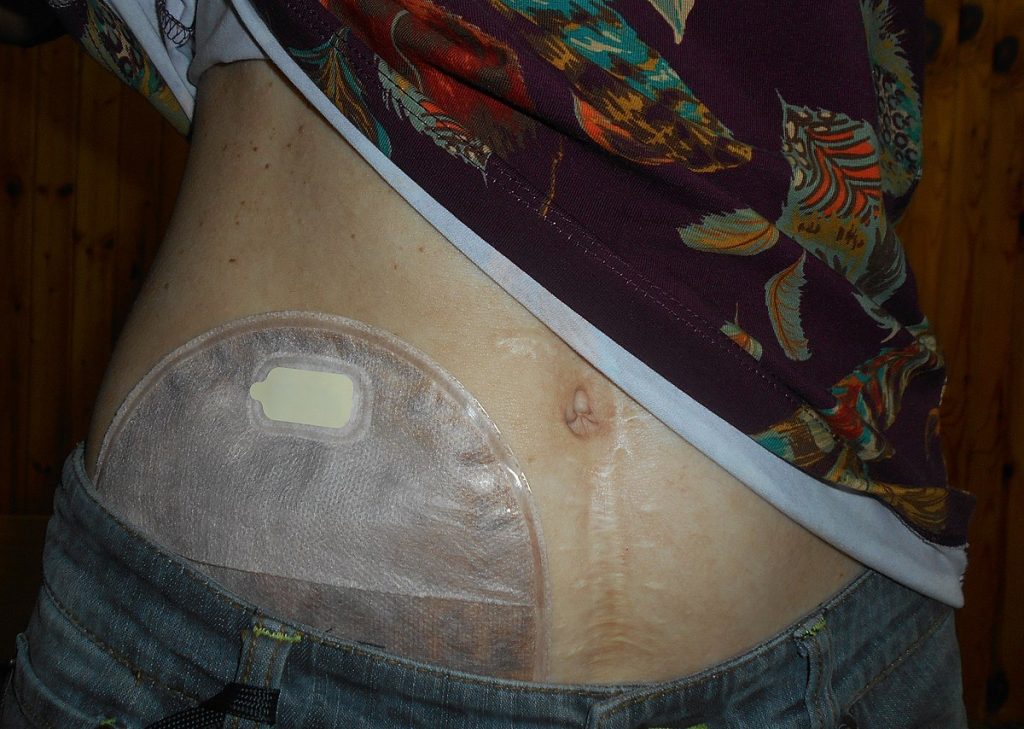 Photo showing drainage bag attached to a wafer