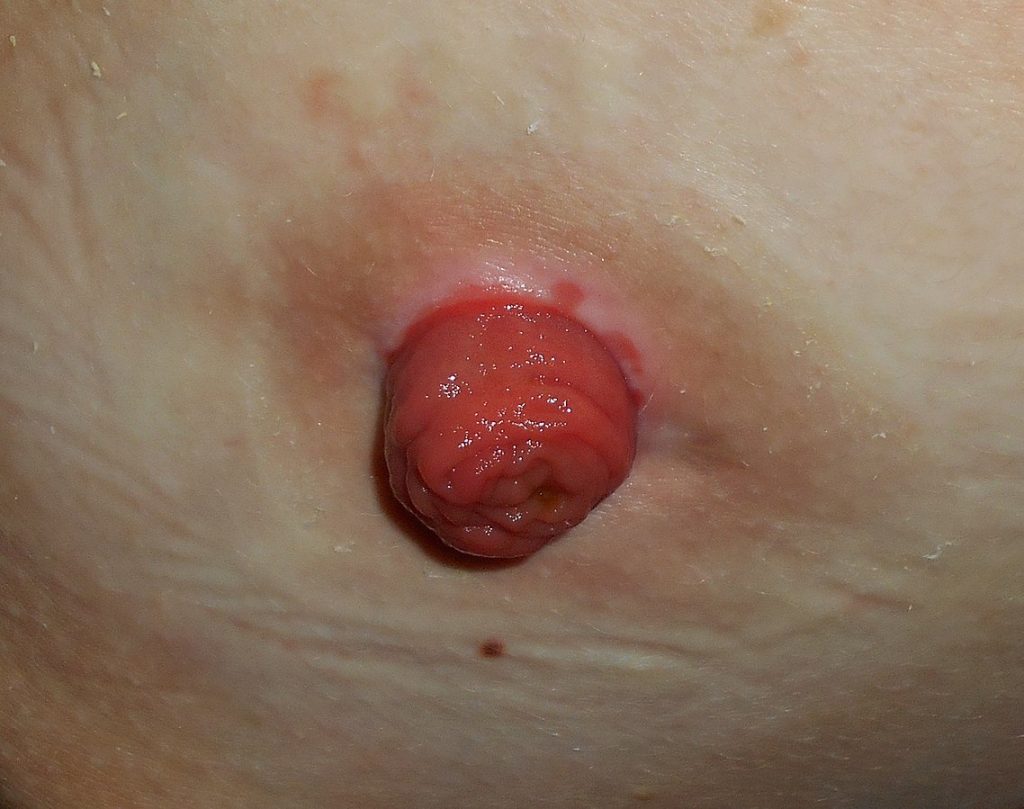 Photo showing a closeup of a stoma