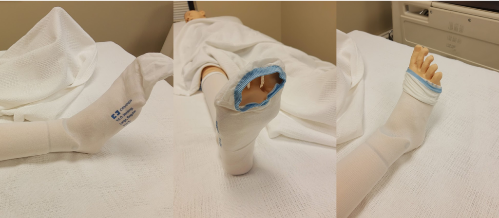 Photos showing TED Hose Covering Toes and TED Hose at the Base of the Toes